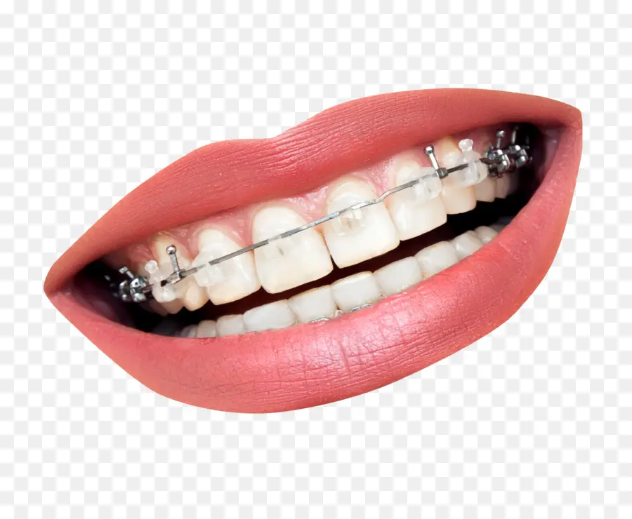 брекеты，стоматология PNG