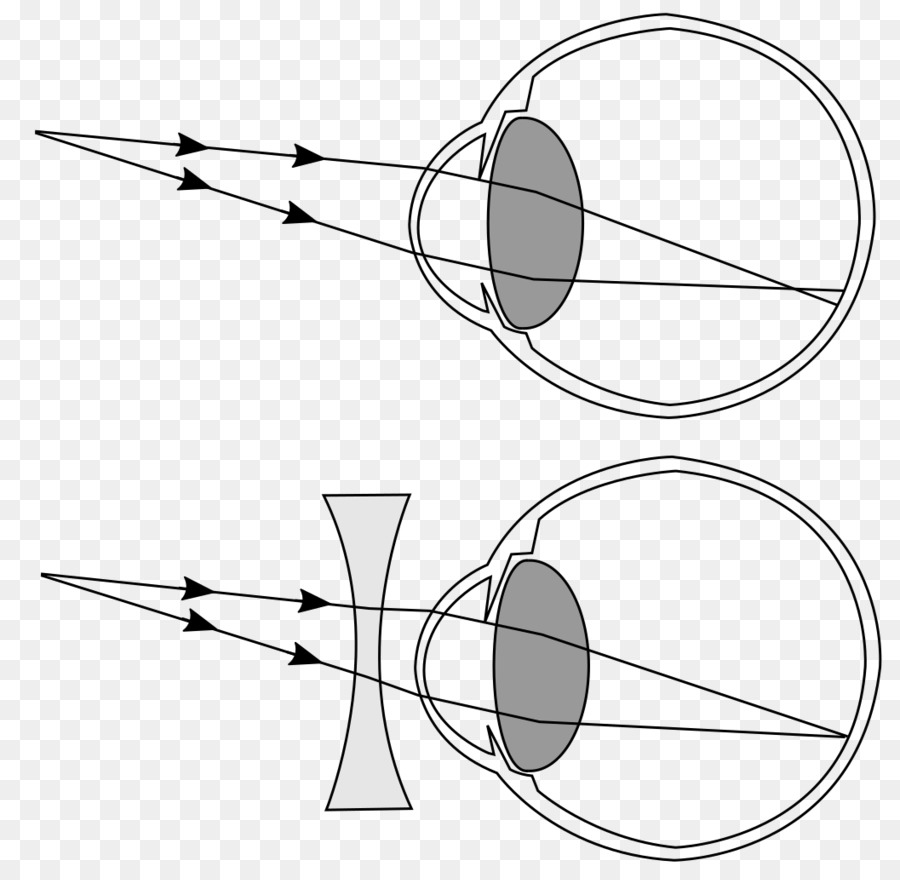 Как формируется изображение при близорукости