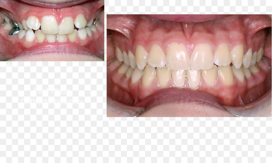 зуб，протезы PNG