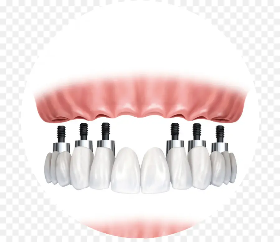 зубной имплантат，стоматолог PNG