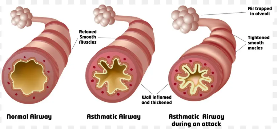 астма，дыхательных путей PNG