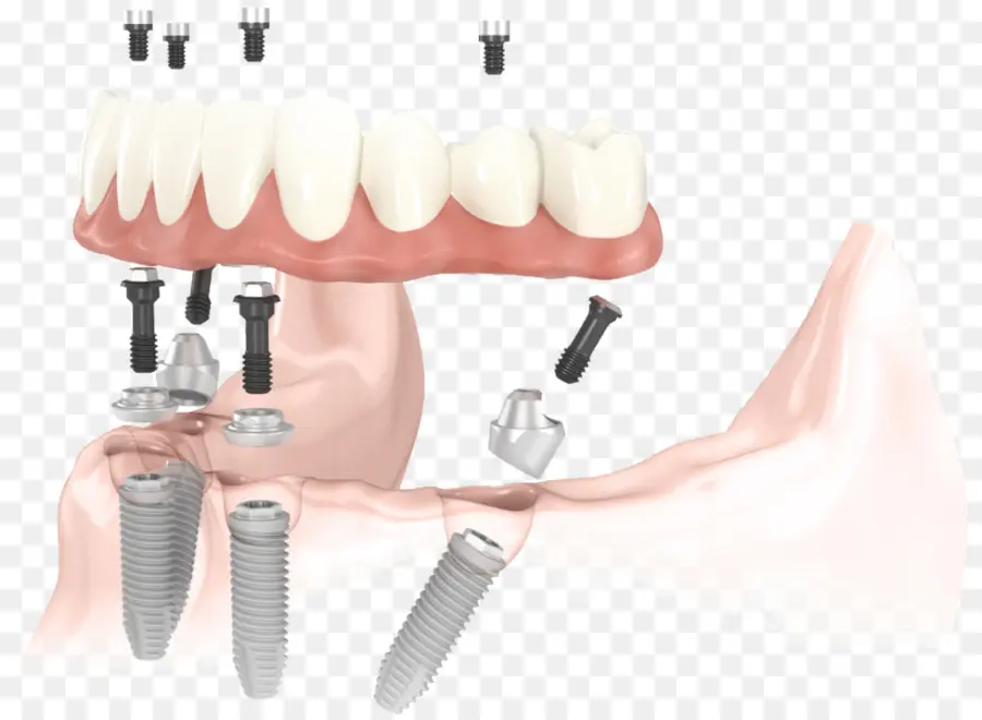 Зубной имплантат，стоматология PNG