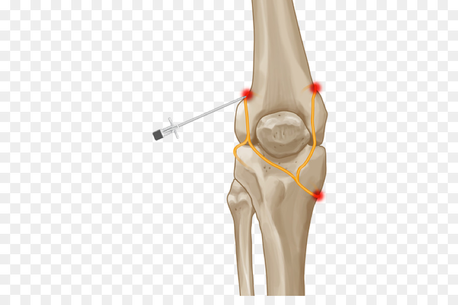 Иллюстрация хирургии колена，колено PNG