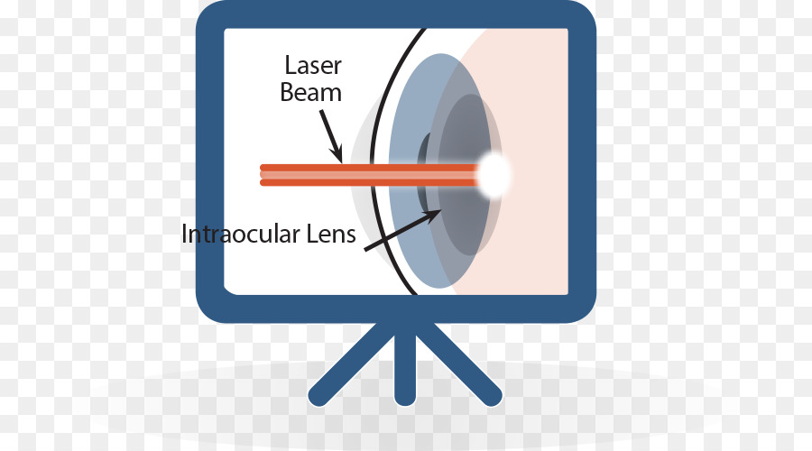 катаракта，лазер PNG