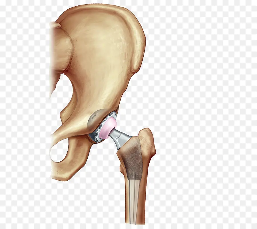 Иллюстрация замены тазобедренного сустава，тазобедренный сустав PNG