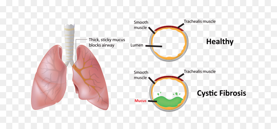 Фиброз у детей. Муковисцидоз кистозный фиброз. Муковисцидоз (cystic Fibrosis).