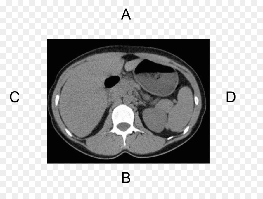 компьютерная томография，кость PNG