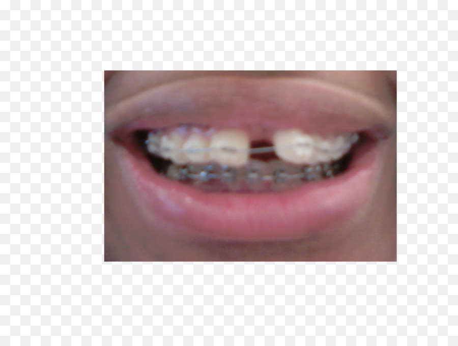 Closeup，зуб PNG