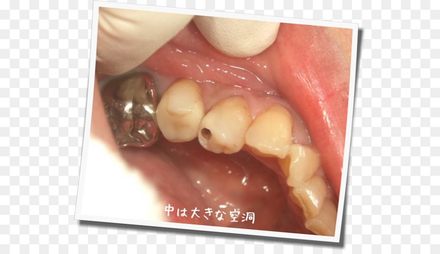человеческий зуб，зуб PNG