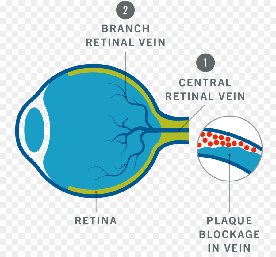 Слепота，окклюзия вен сетчатки PNG