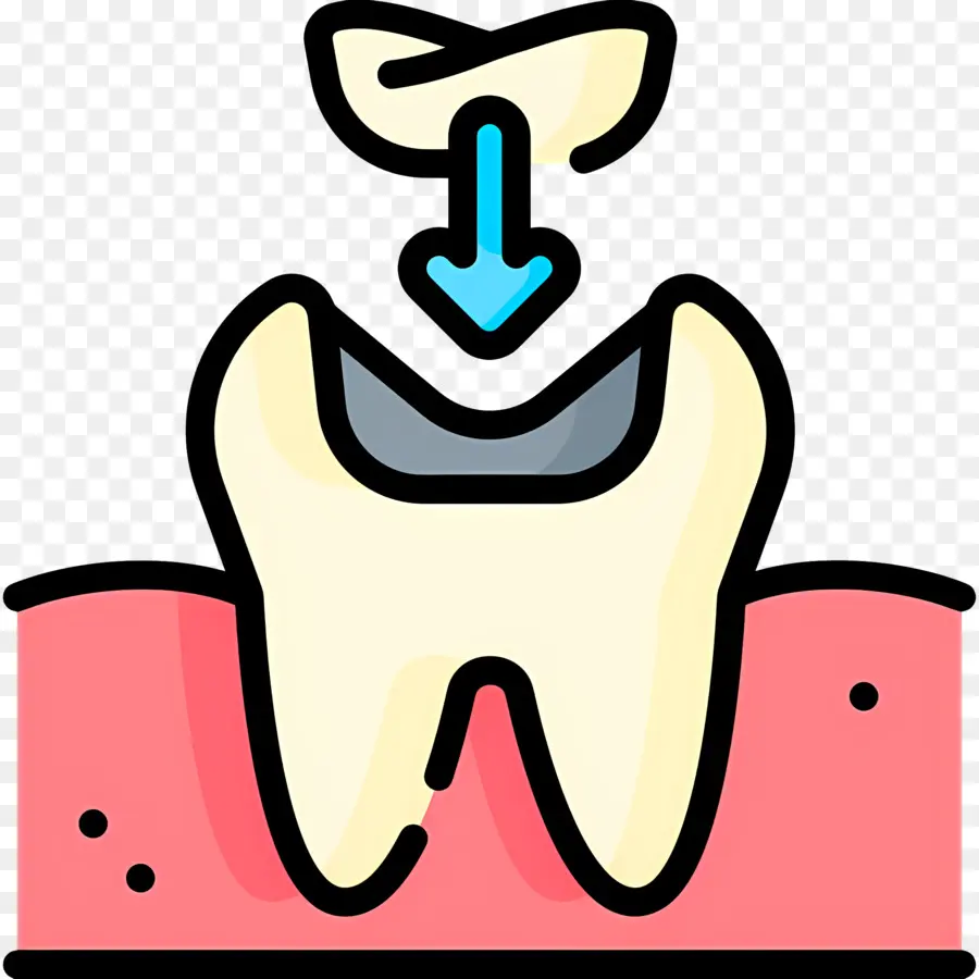 стоматологические，зубная корона PNG
